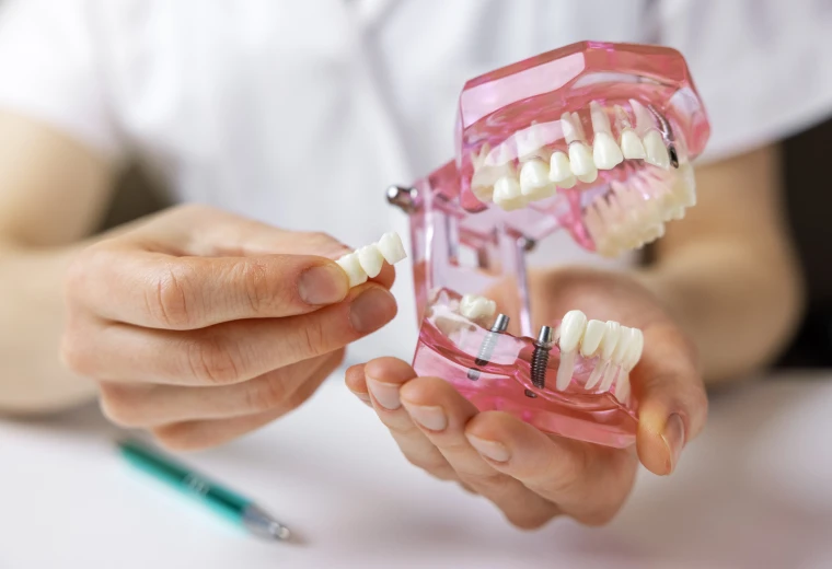Bridge dentaire sur un modèle dentaire avec implant