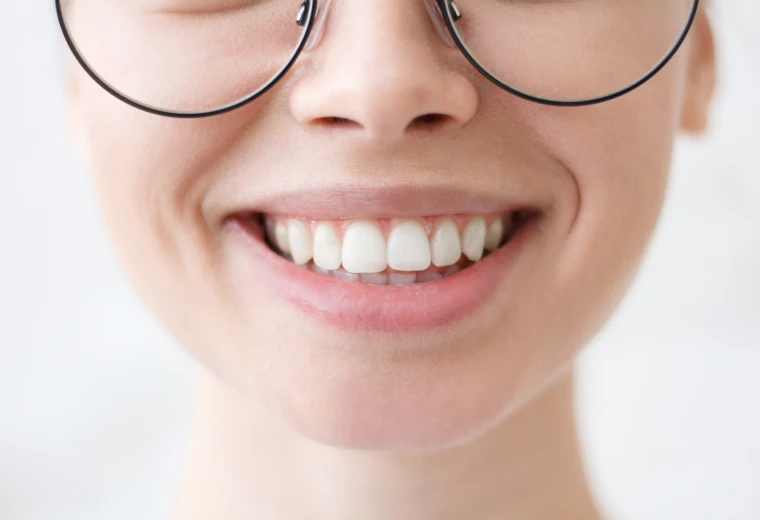 Sourire naturel après une stratification de composite